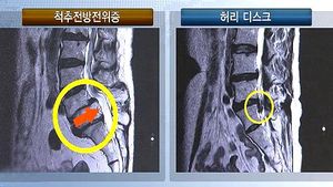 [건강리포트] 여성 허릿병 '척추전방전위증'