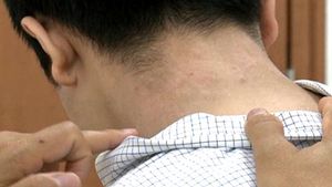 [건강] 성인 아토피 피부염의 원인과 해결법