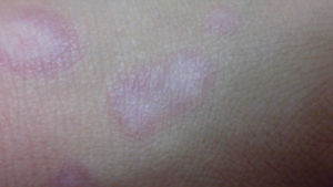 피부에 '하얀 얼룩'&hellip;日 화장품 피해 급증