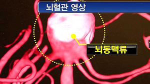 [건강] 두통 심하고 눈 감겼는데&hellip;'뇌 속 시한폭탄'