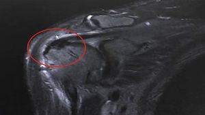 [건강] 관절 내시경 시술로 부작용 없이 해결