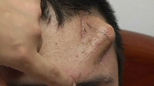 [영상] 이마 위에서 코가 자라는 남성
