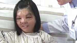 中 17살 소녀, 안면 이식 수술로 새 삶&hellip;감동