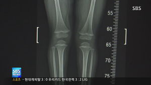 [건강리포트] "비타민 D 부족할 수록 성장통"