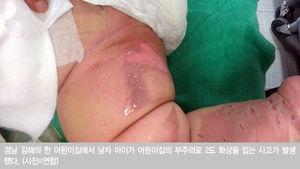 어린이집 부주의로 생후 7개월 영아 2도 화상