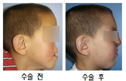 "3D 프린트 기술로 만든 인체조직 이식 성공"