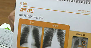 성남 중원구 보건소, 결핵퇴치 운동
