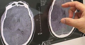 [메디컬리포트] 저체온 요법, 뇌졸중 환자에게 효과