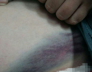 '짓밟고&middot;담뱃불로 지지고'&hellip;여중생 폭행한 겁없는 10대들