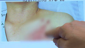 [건강리포트] "바늘로 찌르는 듯한 통증"&hellip;대상포진 환자 늘어