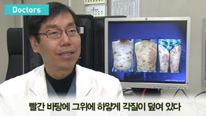 [닥터스] 빨간 바탕에 하얀 각질&hellip;건선, 원인과 예방법은?