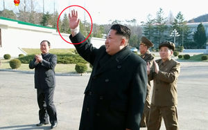 의사들 "김정은 손목 부상 가벼운 상처로 보여"