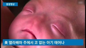 [생생영상] 미국에서 태어난 코 없는 아기&hellip;가슴 아픈 사연