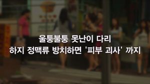 [닥터스] 울퉁불퉁 다리&hellip;하지 정맥류, 방치하면 피부 괴사까지