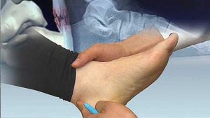 운동하다 갑자기 '뚝'&hellip;아킬레스건염 주의