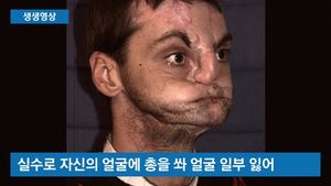 [생생영상] 실수로 얼굴에 총 쏜 男&hellip;다시 되찾은 삶 '뭉클'