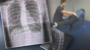 점점 굳어지는 마디마디&hellip;늘어나는 '강직성 척추염'