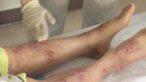각질에 가려움증&hellip;가을철 불청객 '피부건조증'