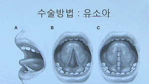 [건강리포트] 아이 '짧은 혀 수술' 급증&hellip;"18개월까진 기다려야"