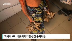 [비디오머그] '나무손' 청년 화제&hellip;10년 전부터 희귀질환