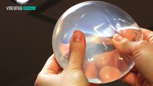 [자막뉴스] 딱딱해지고, 터지고&hellip;가슴 보형물 부작용 잇따라