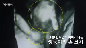 [비디오머그] '내가 지켜줄게' 손 꼭 잡은 쌍둥이 초음파 사진