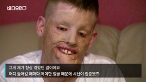 [비디오머그] 사고로 얼굴 잃은 남자 '페이스오프'&hellip;안면이식 수술 결과는?