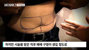 [자막뉴스] 시술 받은 후 배에 '구멍'&hellip;한류 의사의 정체