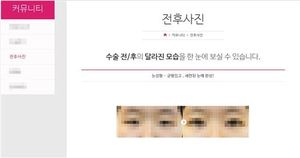 日여고생, 쌍꺼풀 수술사진 무단도용 한국 성형의 고소