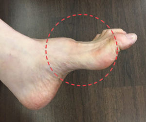 이재현 회장이 앓는 '샤르코마리투스병'은