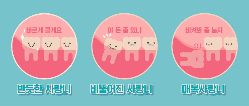 사랑니의 종류