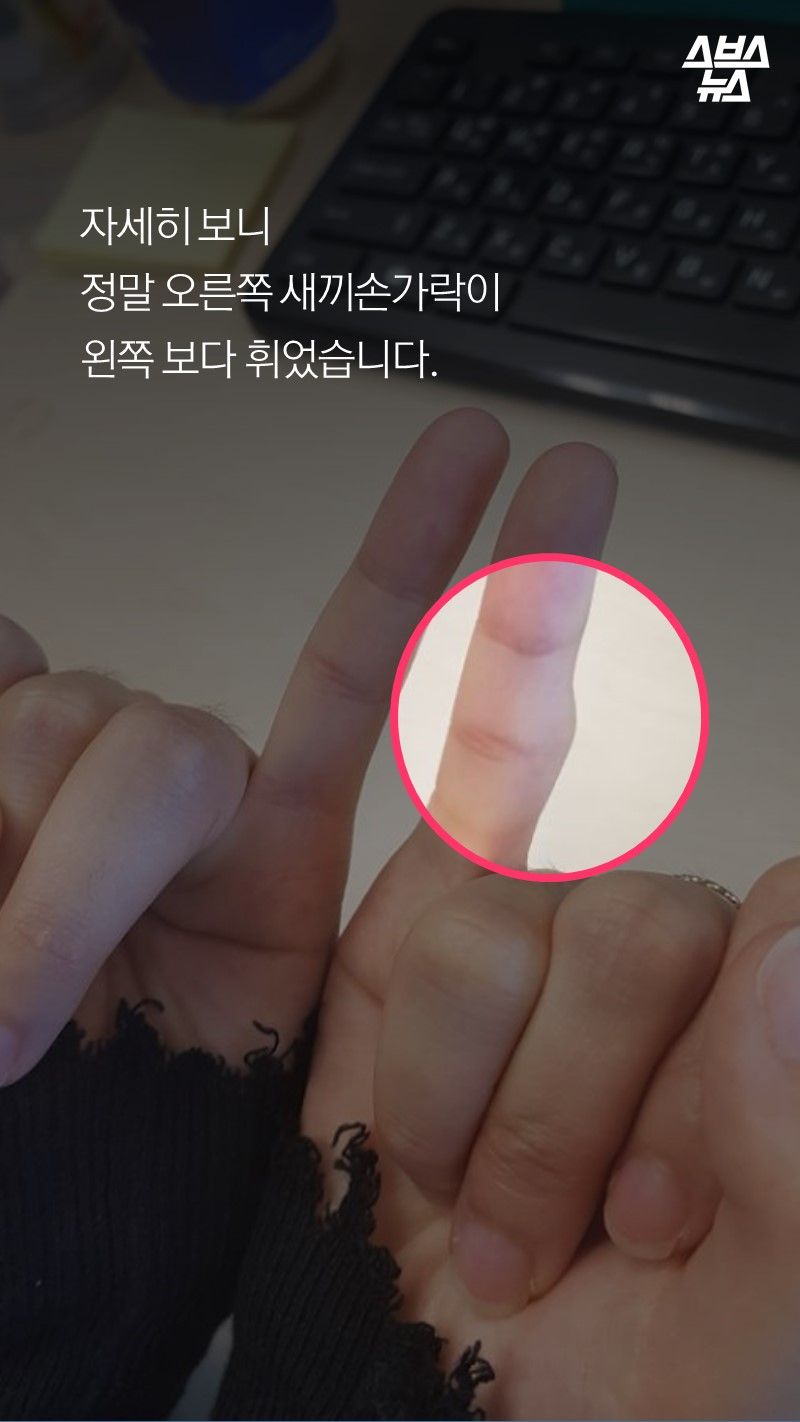 자세히 보니
정말 오른쪽 새끼손가락이
왼쪽 보다 휘었습니다. 