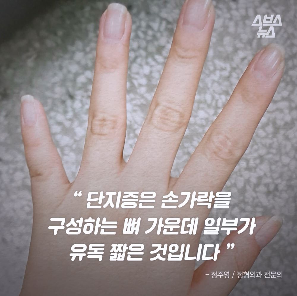 "단지증은 손가락을 구성하는 뼈 가운데 일부가 유독 짧은 것입니다. 
