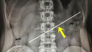 [뉴스pick] 술자리 내기로 볼펜 심 삼킨 남자&hellip;치료비로 돈 잃고 '후회 막심'