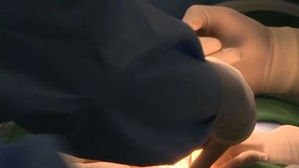 모발이식 시술받던 40대 남성 돌연사 "수면마취 상태&hellip;"