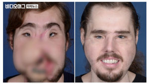 의료진 100여 명 뛰어든 안면이식&hellip;새 삶을 선물하다