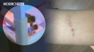 [단독] 어른에게 물린 아이 '불안장애'&hellip;"좀비놀이했을 뿐"