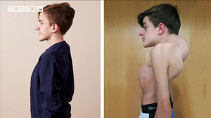 '매시간 휘어지는 척추' 18번의 수술 끝에 새 삶을 찾은 소년