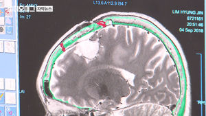 뇌암 치료 길 여는 '장벽' 자물쇠 풀렸다&hellip;임상시험 진행