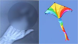[Pick] 친구랑 연날리기하다 강풍에 '손가락 3개' 잘린 50대 남자