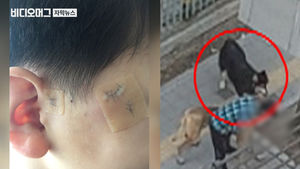 수십 미터 달려 8살 아이 덮친 대형견&hellip;얼굴 곳곳 물었다