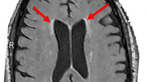 "고혈압 공격적 치료, 치매 위험↓"