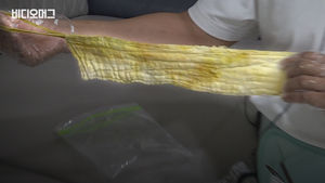 수술 뒤 뱃속에서 35cm 거즈가&hellip;"내가 먹었다고?"