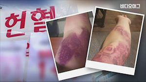 헌혈하다 동맥 파열됐는데&hellip;혈액원 "보상 방안 논의 중"