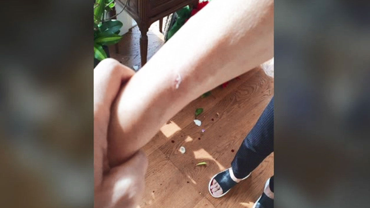 이명희 손 상처