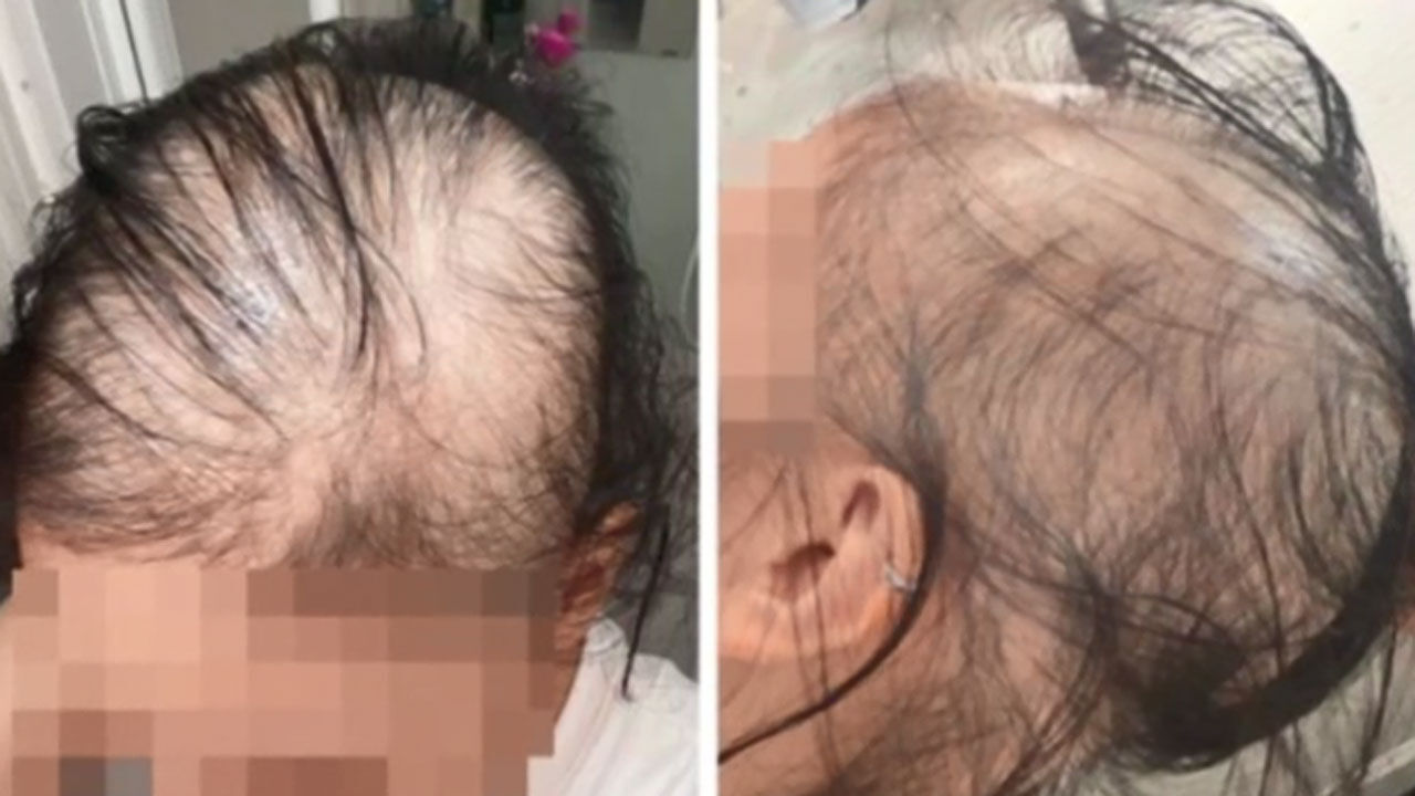 [뉴스쉽] 일본 여성 탈모 사진