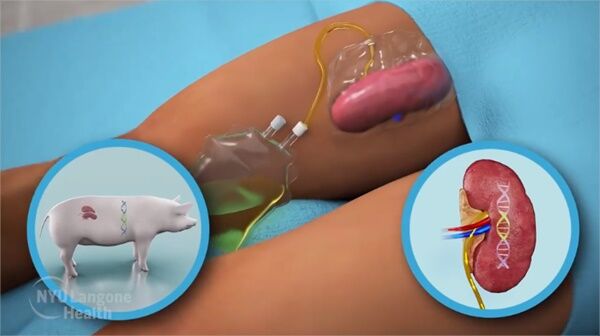 [Pick] 美 뇌사 환자에 '돼지 신장' 이식 성공…'이종이식 첫걸음
