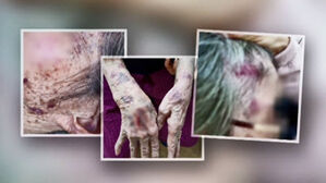 노인보호센터서 보호는 커녕 80대 할머니 '집단 폭행'