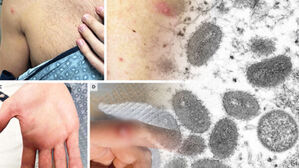 [실시간 e뉴스] 40년 전 맞은 두창 백신, 원숭이두창에도 효과 있을까?