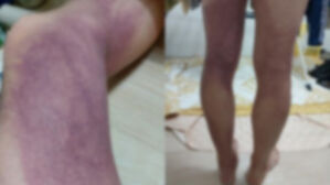 "선 채로 받은 압박, 이 정도" 생존자가 공개한 양다리